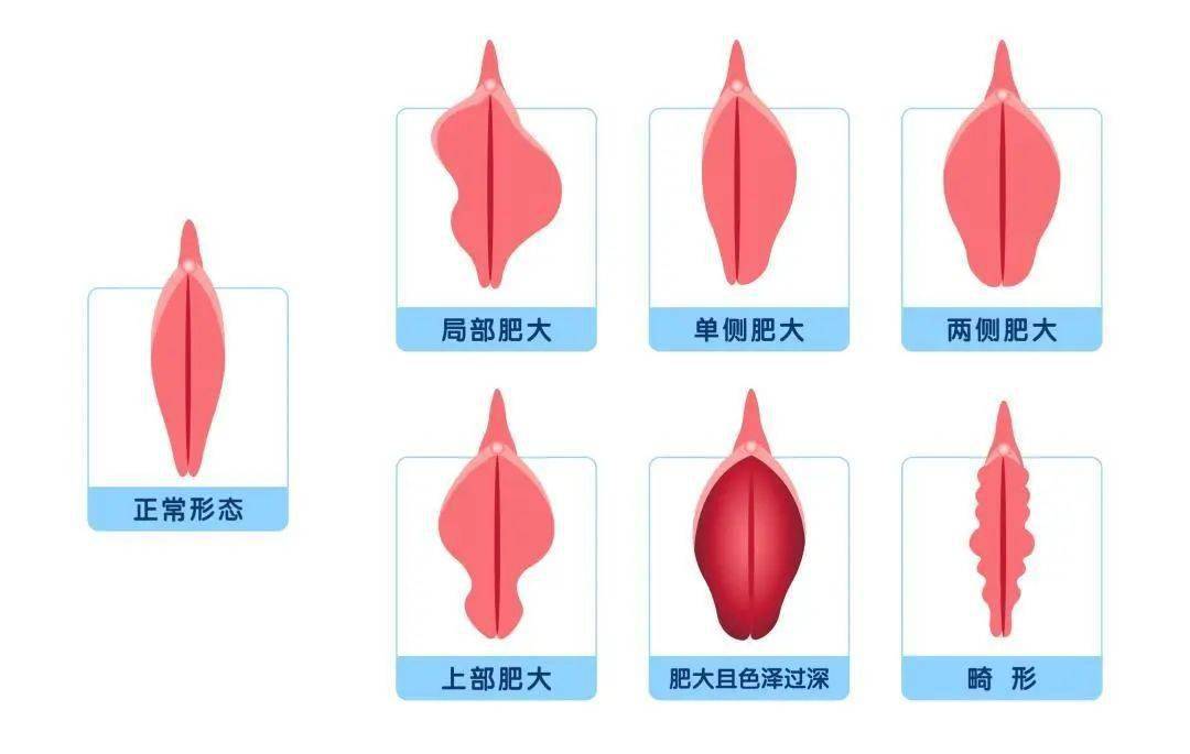 5～2cm,如果小阴唇宽度超过4cm,或者超出大阴唇1cm以上,就可以定义为