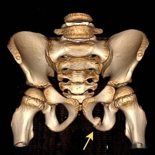 儿童骨盆这种x线表现,谨防误诊