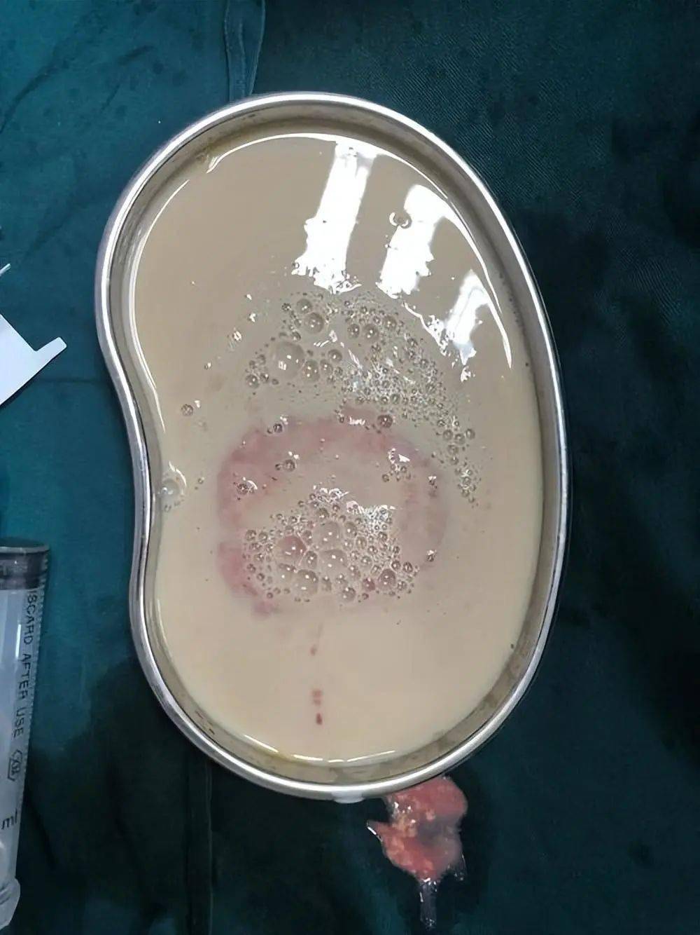 48岁男子腹痛发热,检查肝脏"被掏空了",切开后医生