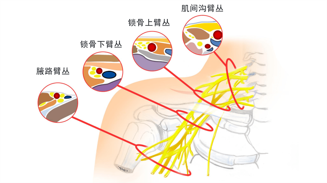 肌间沟三指定位法图片图片