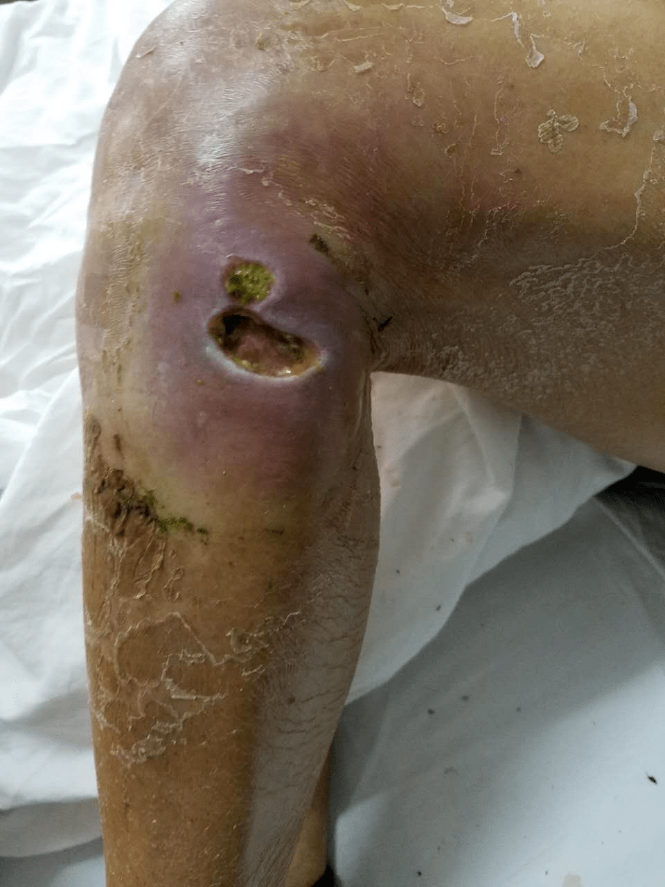 患者70岁,膝关节处湿敷青草药致皮肤软组织感染