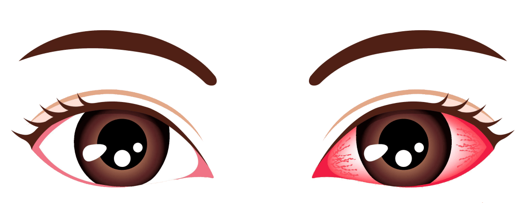 夏季来临,当心"红眼病"_患者_症状_发病