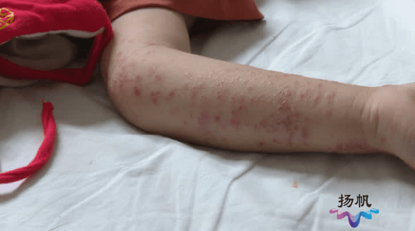 扬州发现多例_患儿_病例_消毒液