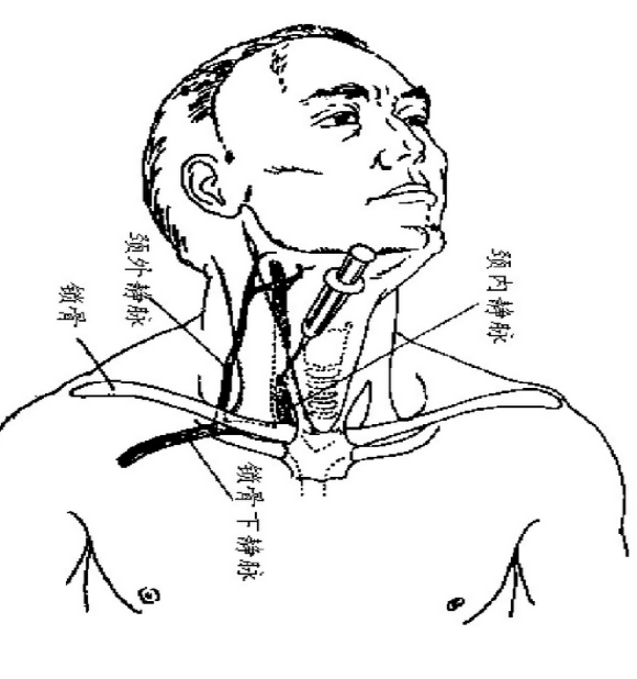 双腔静脉导管的分解图图片