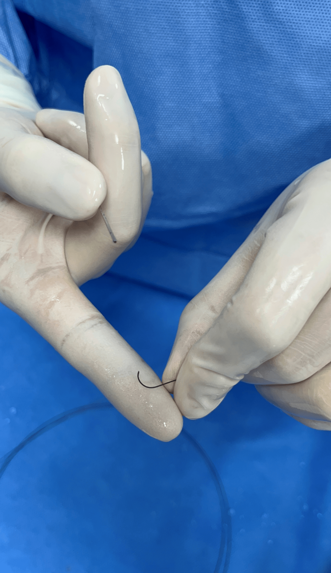 北斗导航丨北斗ss神经血管导丝动脉瘤介入治疗应用体会