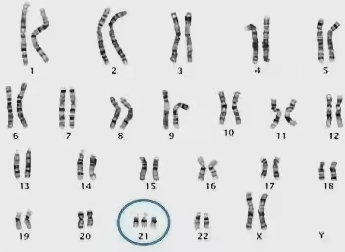 唐氏综合征(ds)又称21一三体综合征,先天愚型,是由于21号染色体异常