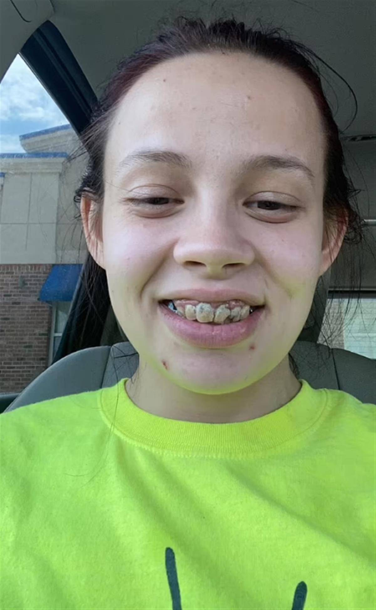 29岁女子一口烂牙不敢微笑,忍痛拔掉了21颗牙,戴着假牙生活