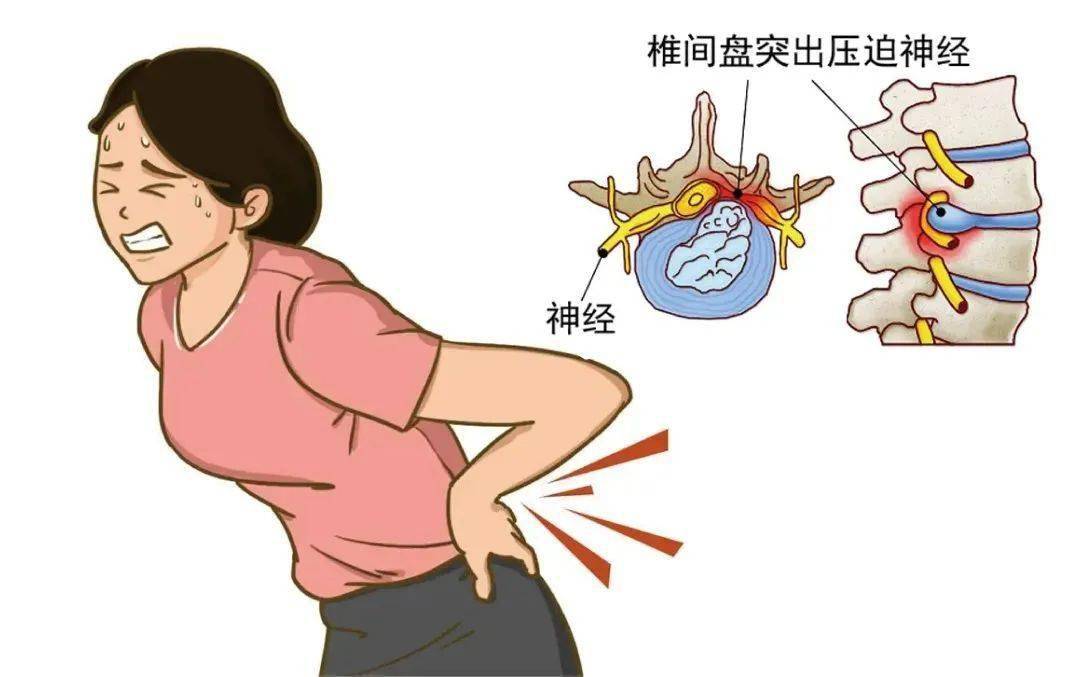 中医治疗|腰酸背痛!这四个原因要警惕!_疾病_肌肉_症状