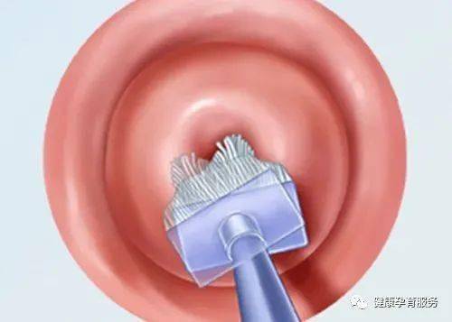 妇科医生检查时,通过阴道窥器可以看到宫颈口的样子,健康的宫颈,看