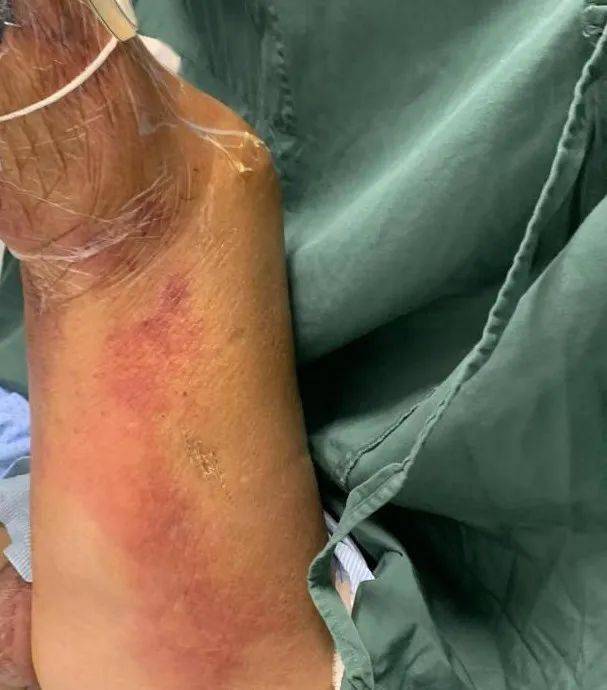 77 岁大爷整条腿发黑布满血疱,肉正在被一口一口吃掉…_患者_创面