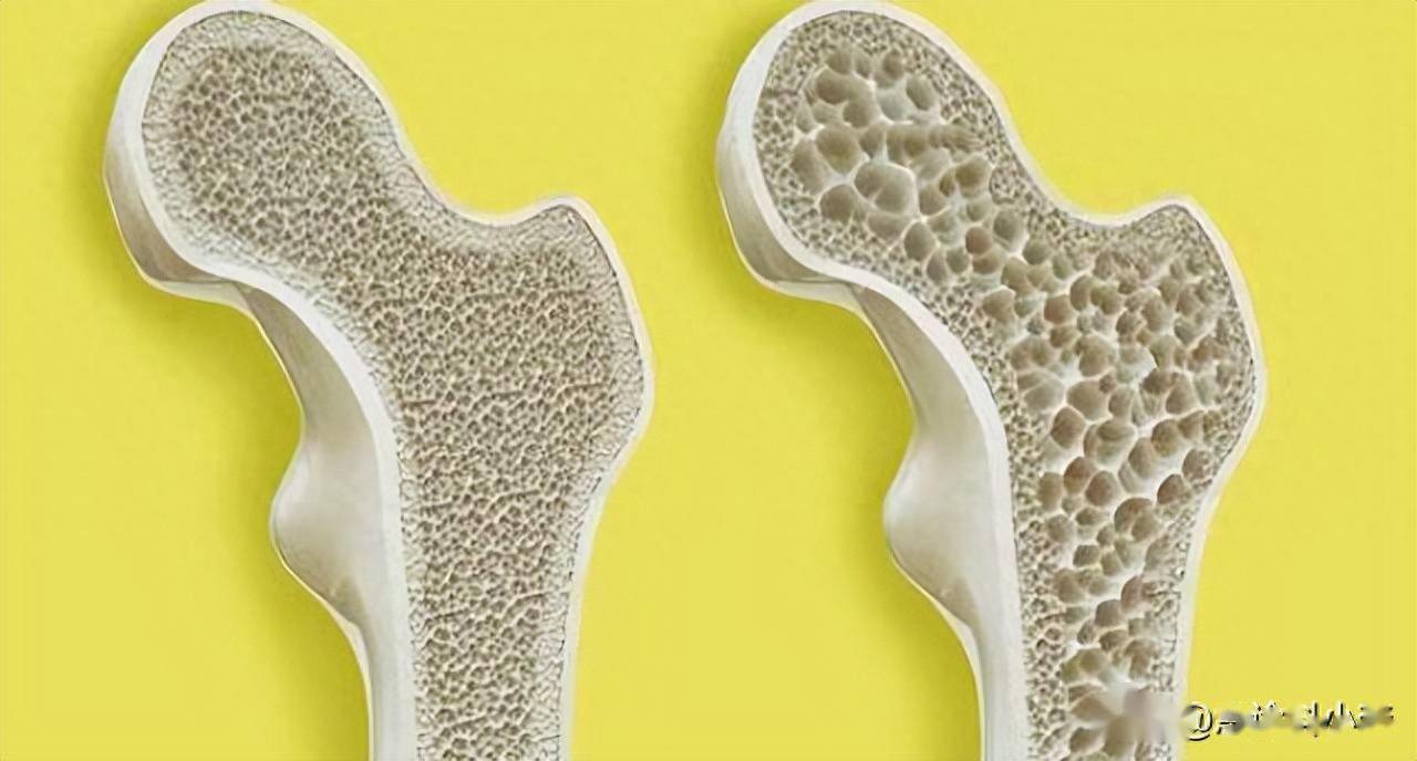 提醒:喝骨头汤不补钙,3种食物要少吃_中老年人_骨骼_医生