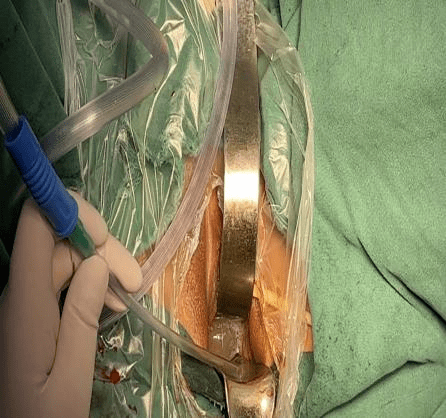 宫颈锥切手术全过程图片