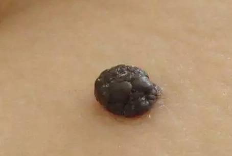 5个早期症状,帮你远离可癌中之王_皮肤_肿瘤_紫外线