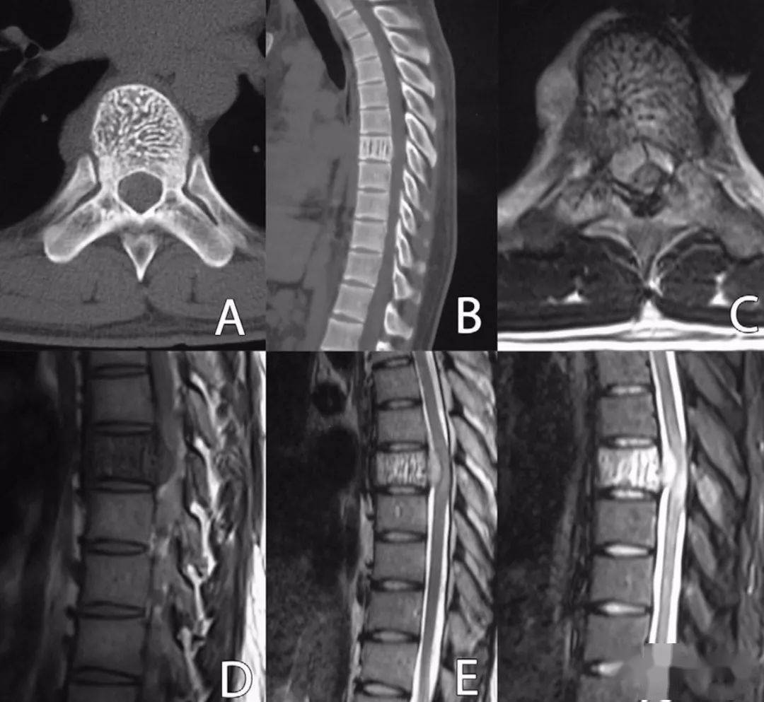 脊椎里长瘤的症状图片图片