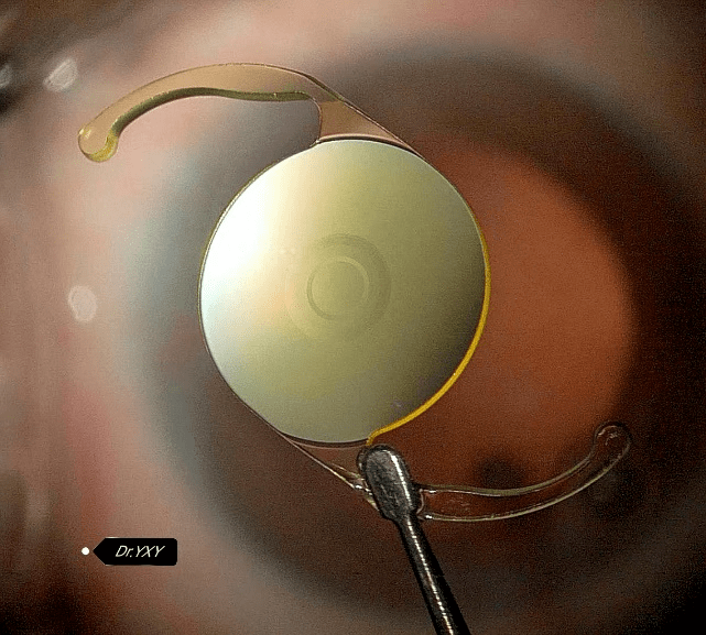 探索功能性iol"新大陆":vivity iol在玻切术后并发性白内障中的应用