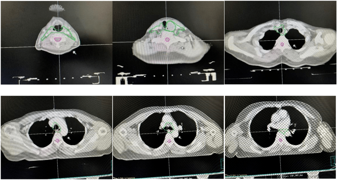 勾画(1)gtv勾画放疗方案:化疗方案:紫杉醇(白蛋白结合型),奈达铂30mg