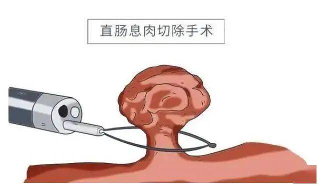 【小南话科普】"善良"的肠息肉,不总是善良_癌变_复查_治疗