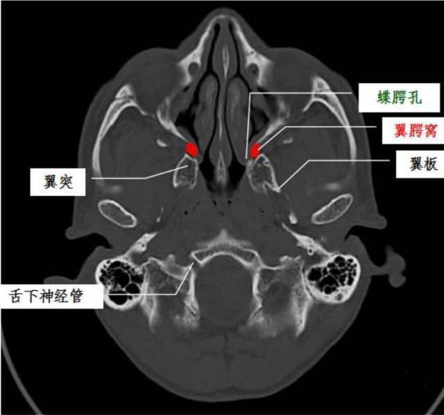 翼颚窝的相关解剖你能分清吗?赶紧看看这篇文章吧!_上颌_神经_全网