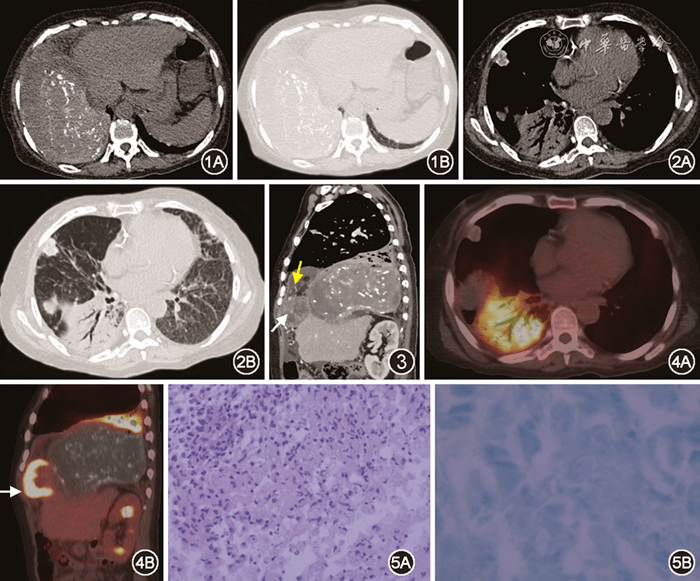 【病例报告】巨型胸膜结核瘤1例_患者_密度_胸腔