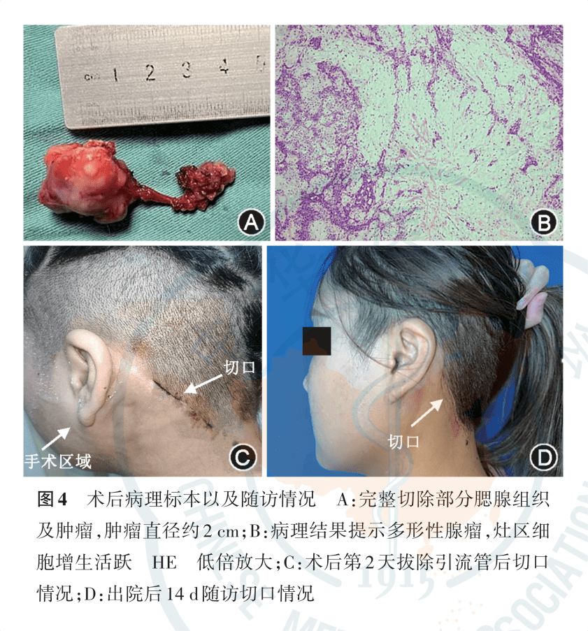 达芬奇机器人辅助下经耳后发际线切口腮腺良性肿瘤切除1例