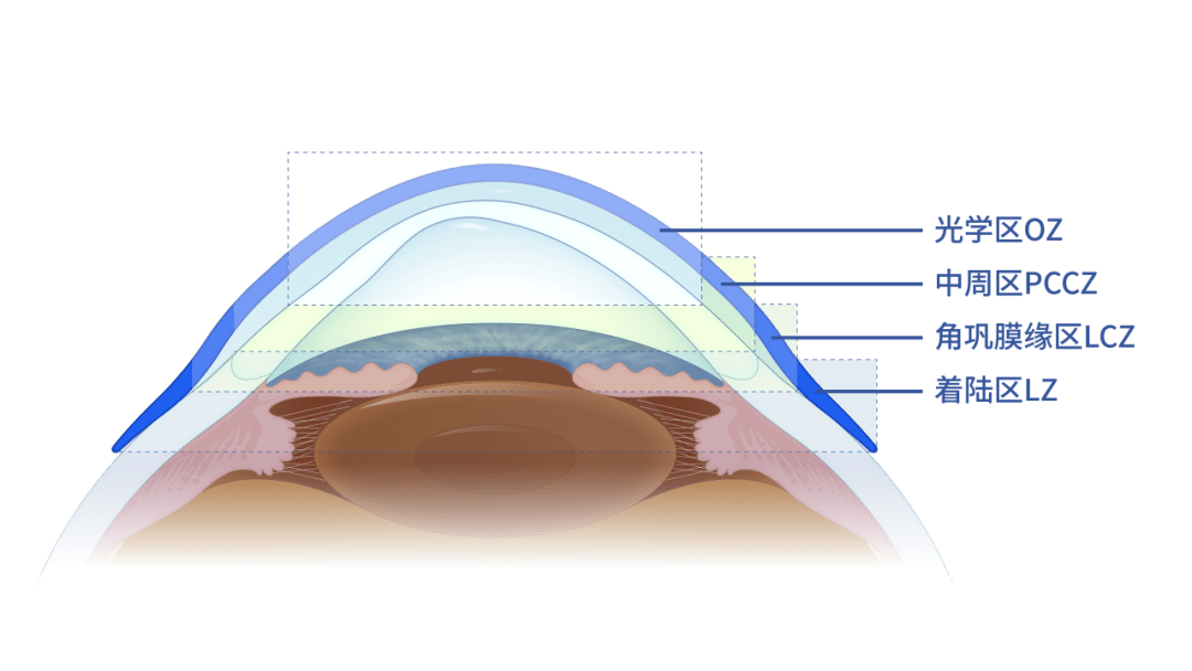 2023海河眼科国际论坛学术交流会之"巩膜镜临床应用论