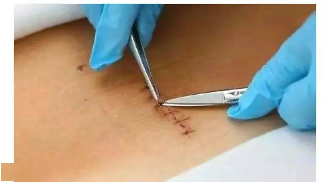 原创科普丨关于手术后拆线的那些事儿~_伤口_切口_情况