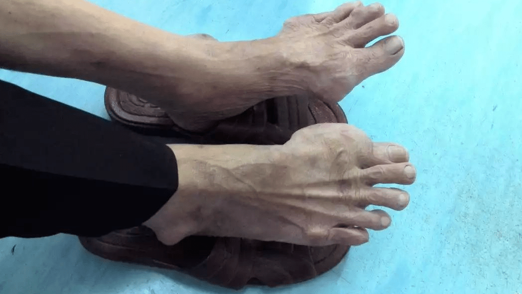 沧州14岁男孩餐餐外卖配饮料,结果脚趾长满了"石头"!_黄骅_尿酸_右脚