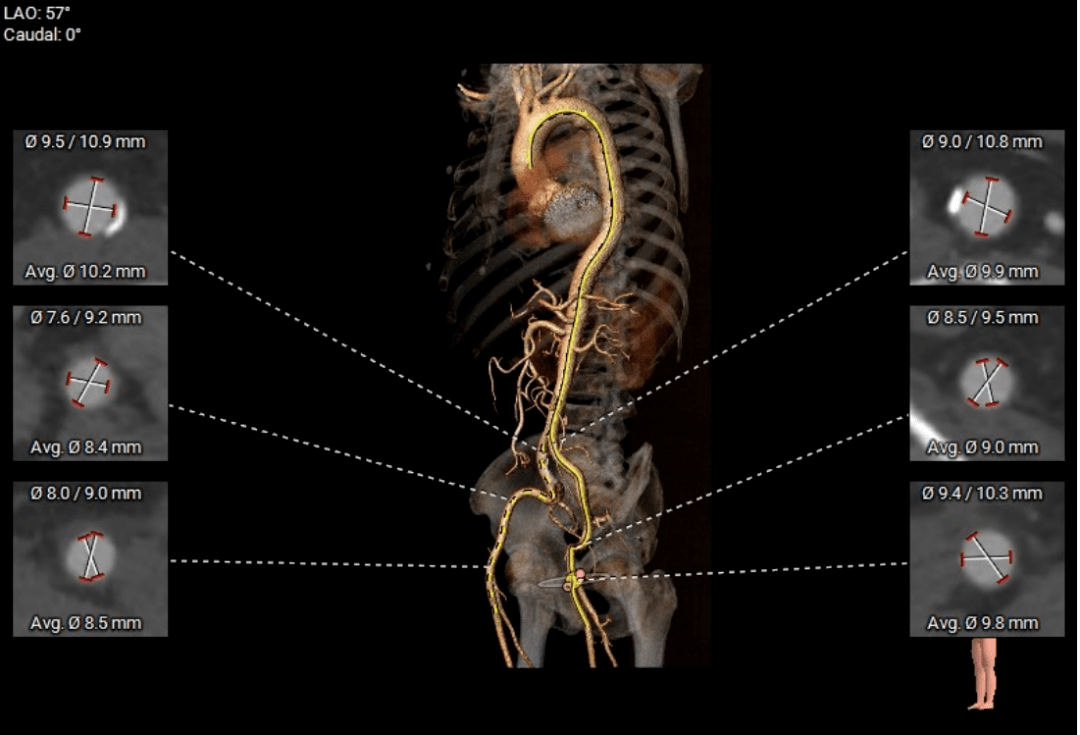 "贞"心一"课"|单纯反流横位心taurustrio一例_手术_瓣膜_定位