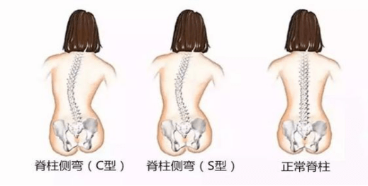 骨盆前倾4将两腿并拢,踝关节接触时,如果膝关节处有空隙,为膝内翻o型