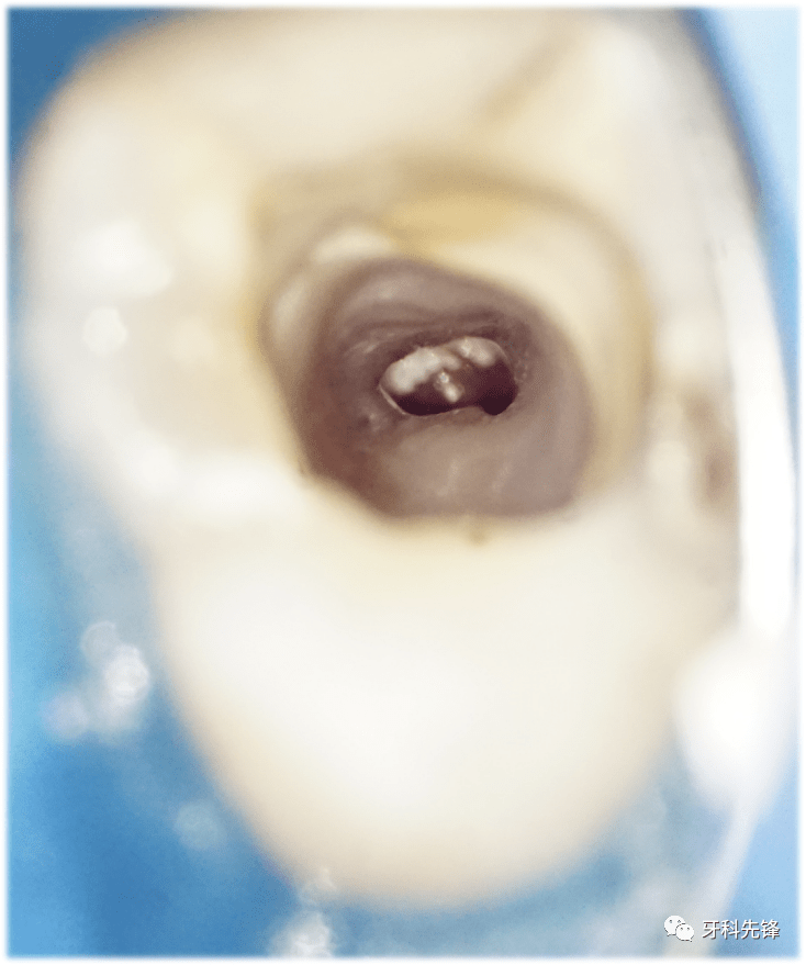 【病例】上(牙合)第二磨牙根尖屏障术一例_治疗_诊断_口腔