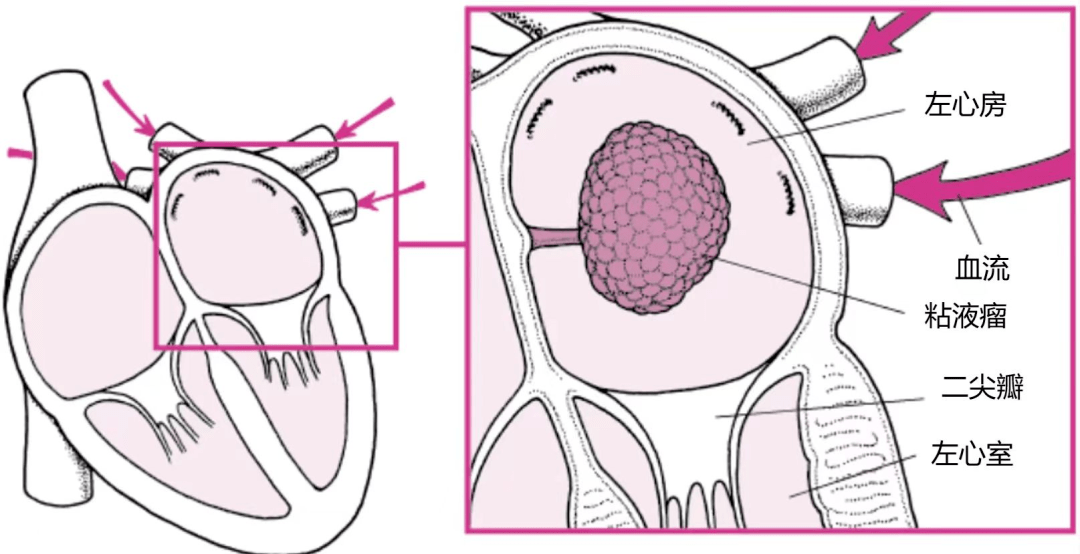 竟是吵架惹的祸!——心房黏液瘤脱落致脑栓塞