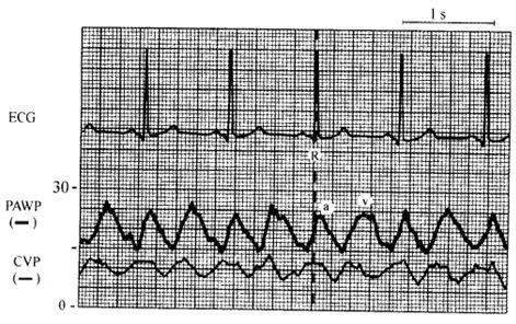 循环监测 | 心脏瓣膜病的血流动力学表现_曲线_患者_二尖瓣