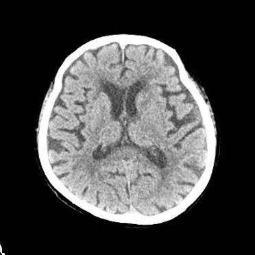 脑白质变性,脑萎缩双侧基底节区及双侧半卵圆中心区腔隙性脑梗塞
