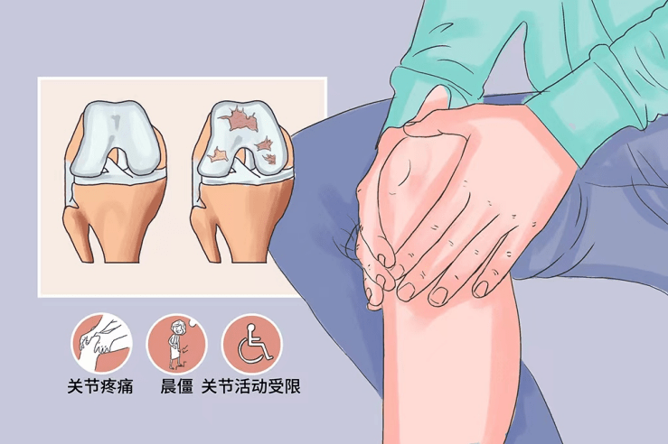 【医文医话】康复中心:膝关节弹响,康复有方法