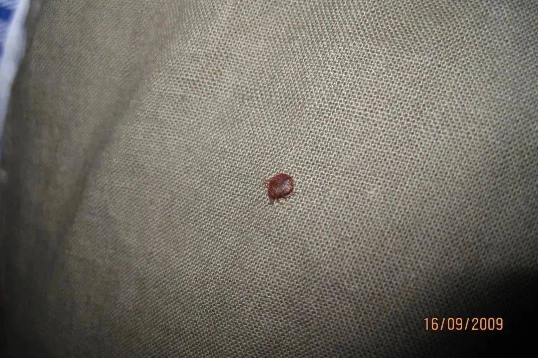 多国再现“床虱”，已蔓延至亚洲……_臭虫_法国_包括