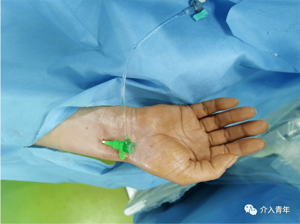 不可掉以轻心的桡动脉穿刺,常见并发症都整理好了!_压迫_导管_血管