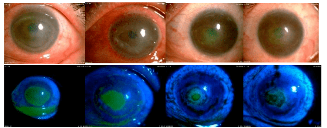case 1:药毒性角膜病变 神经营养障碍和重症眼表疾病中的临床应用病例