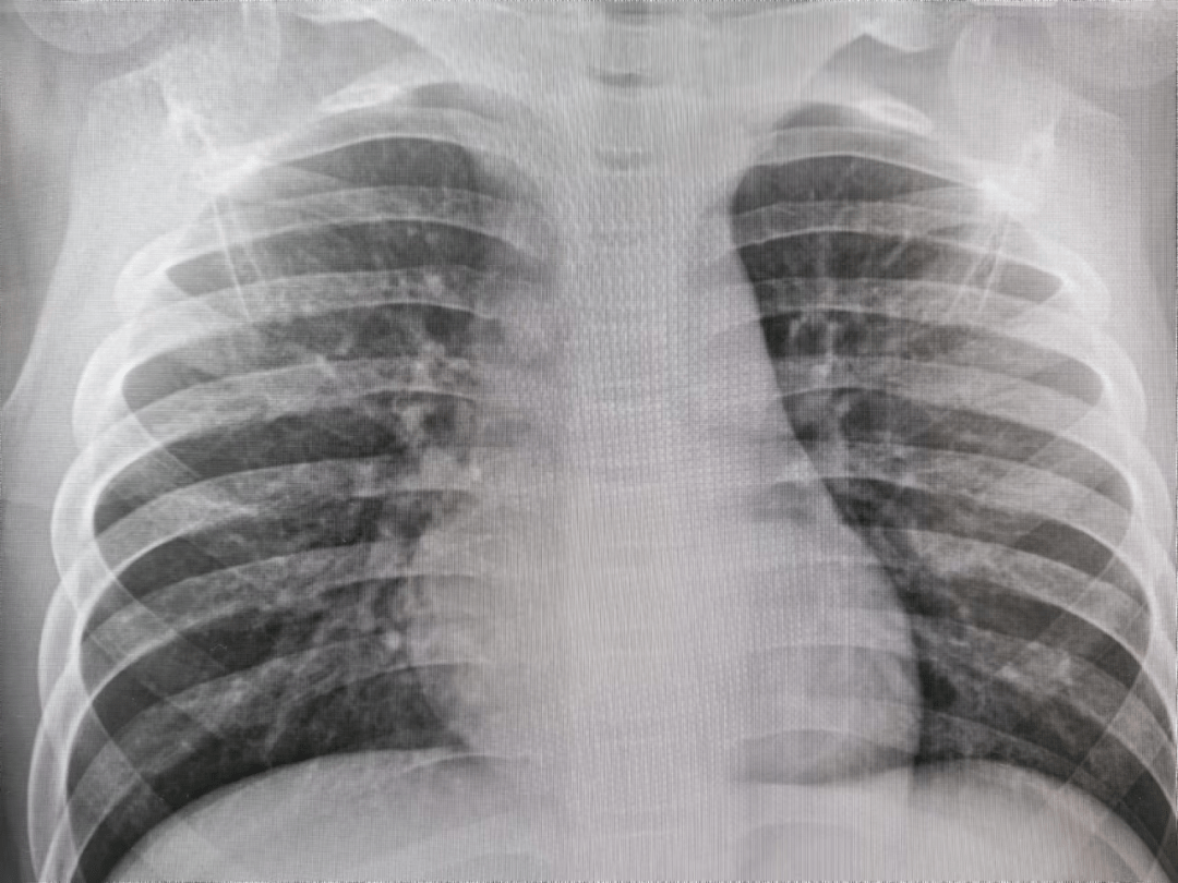 支气管炎x光片图片