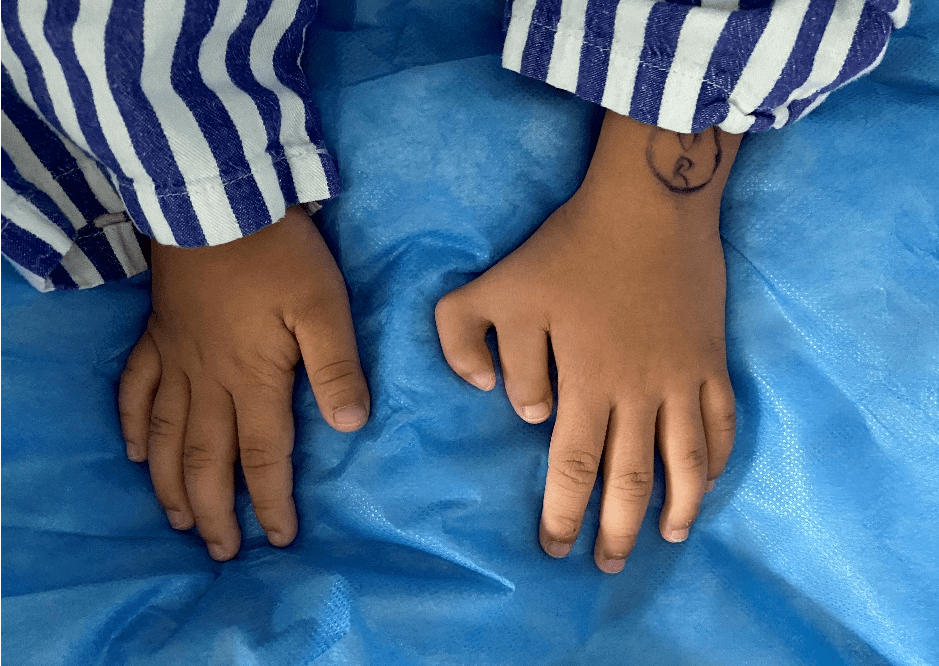 据了解,小黄出生时,父母就发现左手拇指蟹钳样畸形,未治疗,随着患儿的