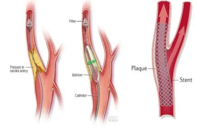 颈动脉支架示意图图片
