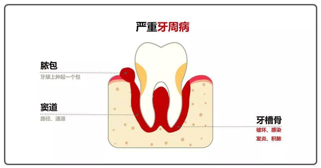 停止自己刺破!_牙齒_牙髓_口腔