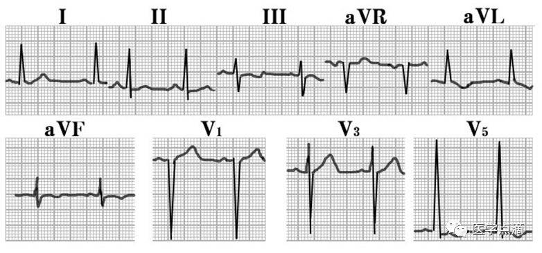 心电图rv5十sv1正常值图片