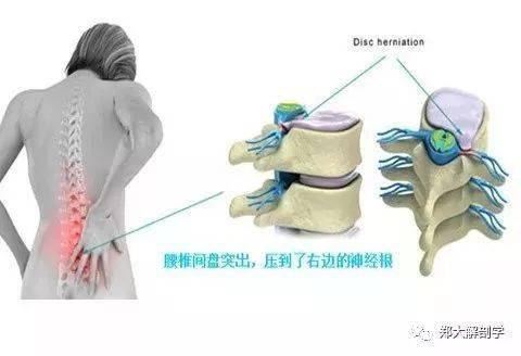 腰椎間盤突出症,您最關心的30個問題_症狀_下肢_患者