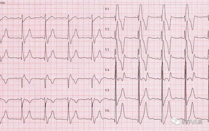 心电图v1到v6图片