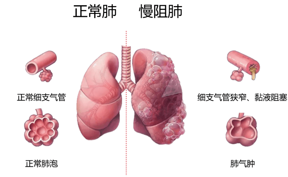 肺气肿的四大体征 来自搜狐网