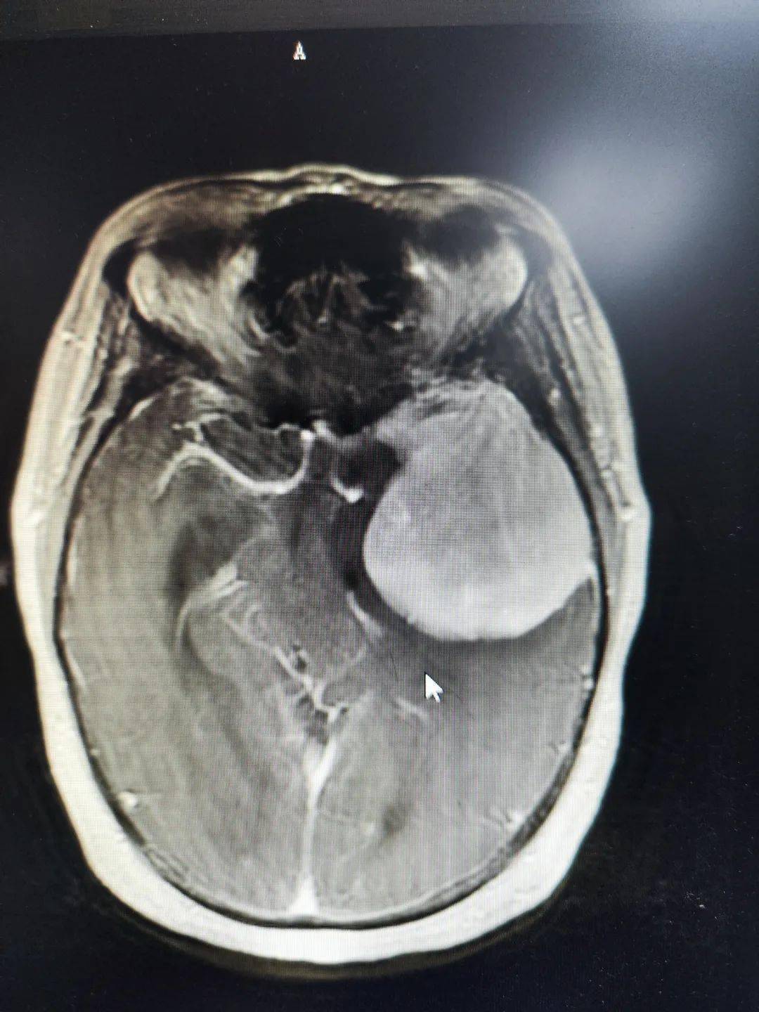 脑膜瘤核磁共振图片图片