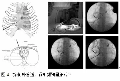 心脏射频消融术相关知识