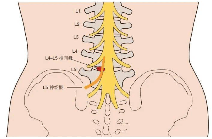 而坐骨神經正是來自l4,l5和s1-s3神經根,所以腰椎間盤突出患者多有