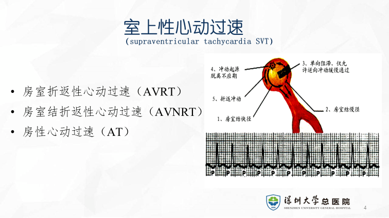 急救|快速性心律失常的應急處理_mg_藥物_治療