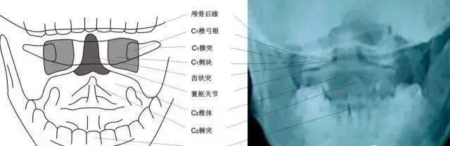 寰齒關節錯位型頸椎病_韌帶_前弓_相關